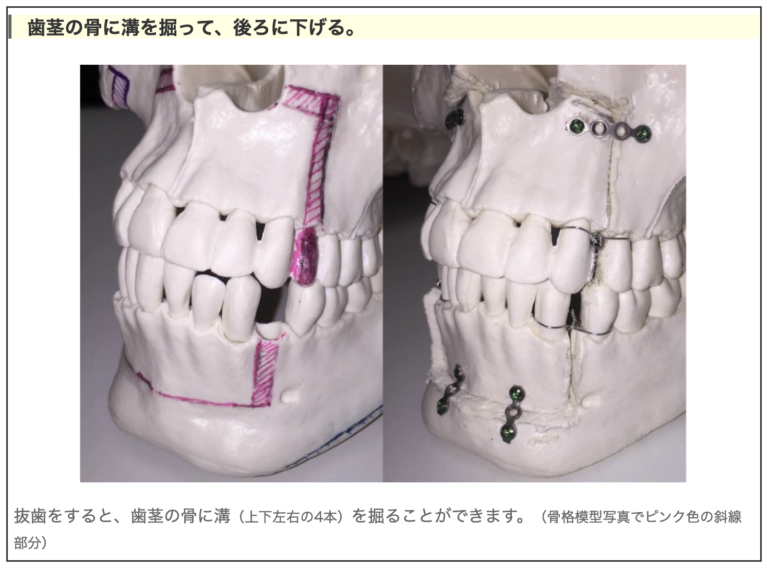 有村藍里 整形手術内容