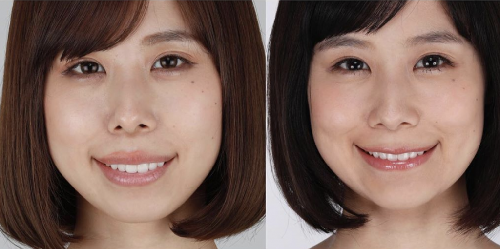 有村藍里 整形内容