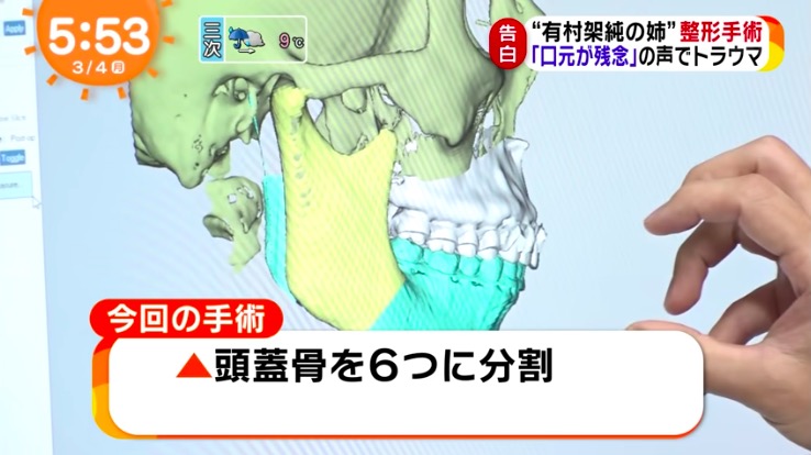 有村藍里 整形手術内容