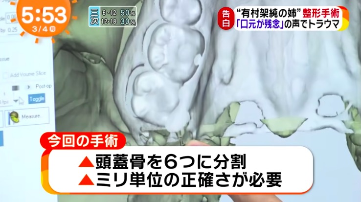 有村藍里 整形手術内容