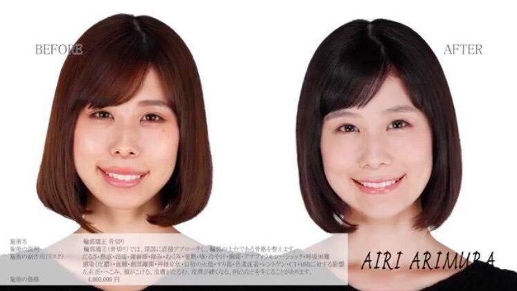 有村藍里 整形手術内容