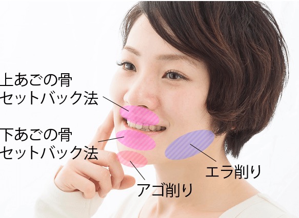 有村藍里 整形手術内容